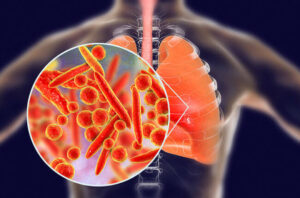 Walking pneumonia: What does it mean?