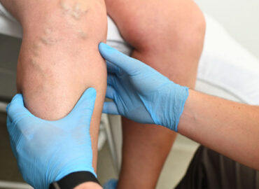 Consequence of Venous and Lymphatic System Dysfunction
